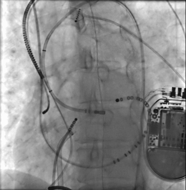 Fluoro image of ablation at the proximal anterior interventricular vein.